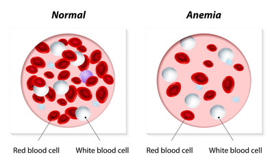 anemia - obrazy, fototapety, plakaty