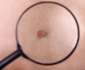 Magnified birthmark  under the magnifying glass