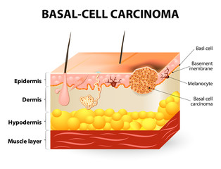 Basal-cell carcinoma or basal cell cancer