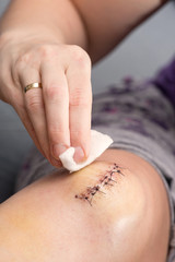 scar from operation with a black fiber