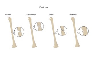 Tipi comuni di fratture