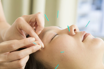 Female acupuncturist to refer to acupuncture to face - obrazy, fototapety, plakaty