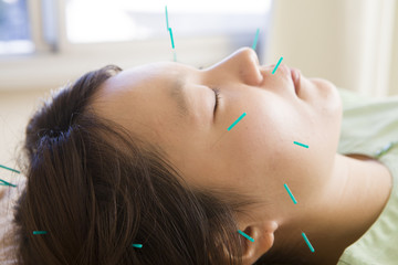 Obraz premium Facial acupuncture