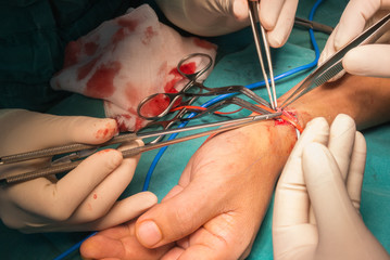 arteriovenous fistula operation for dialysis - obrazy, fototapety, plakaty