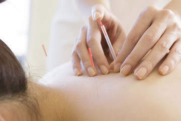 Obraz na płótnie Canvas Woman undergoing acupuncture