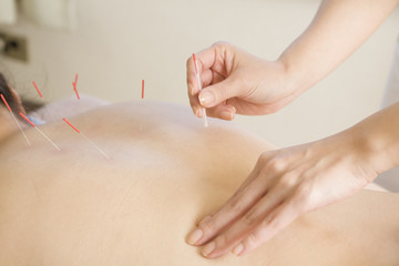Acupuncture treatment of back