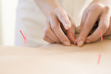 Women undergoing acupuncture waist