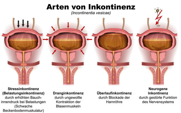 Arten von Inkontinenz, Urologie