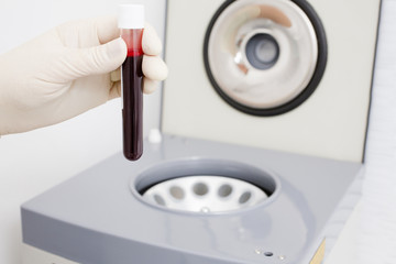 Preparation of blood for injections Plasmolifting