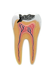 Cross section of a tooth model with caries.