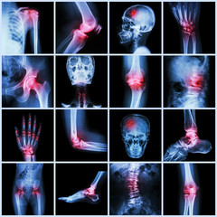 Collection human joint and arthritis and stroke