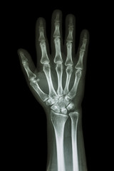 X-ray hand & forearm