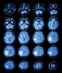 MRI brain : Brain tumor at right parietal lobe