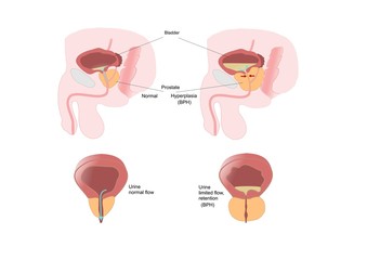 sezione di prostata normale e di ipertrofia prostatica