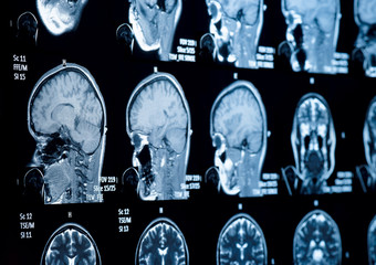 Head and neck MRI scan, anonymized