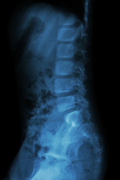 Lumbar spine of child ( X-ray thoracic - lumbar spine )