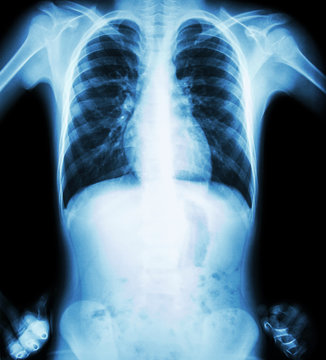 X-ray chest ( akimbo position ) ( front view )