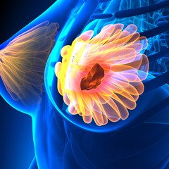 Breast Cancer - Female Anatomy - tumor highlight