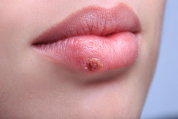 beautiful lips virus infected herpes