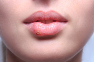 beautiful lips virus infected herpes © kopitinphoto