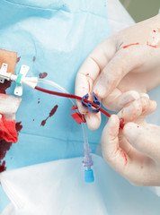 Setting blood catheter in hospital. Close-up