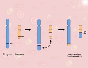 Burkitt's lymphoma translocation