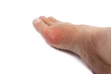 Painful gout inflammation on big toe joint