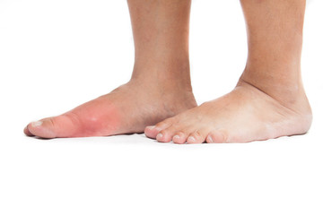 Pair of feet with deformed right toe with gout inflammation.