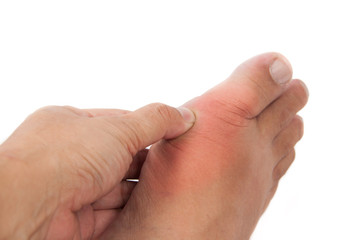 Hand embracing foot with gout inflammation