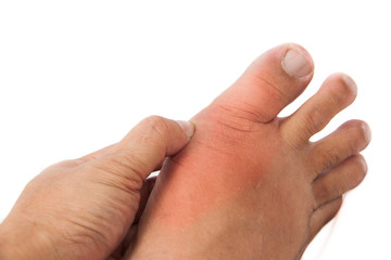 Hand embracing foot with gout inflammation