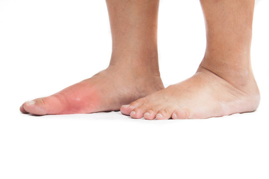 Pair Of Feet With Deformed Right Toe With Gout Inflammation.