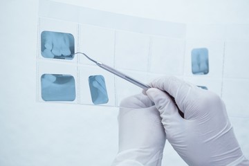 Gloved hand holding dental tool to teeth x-ray