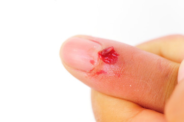 wound in finger