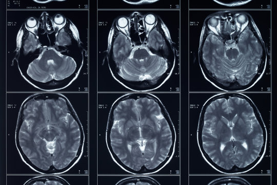 X-ray head and brain