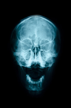 film x-ray Skull AP : show normal human's skull