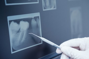 Gloved hand holding dental tool to teeth x-ray - obrazy, fototapety, plakaty