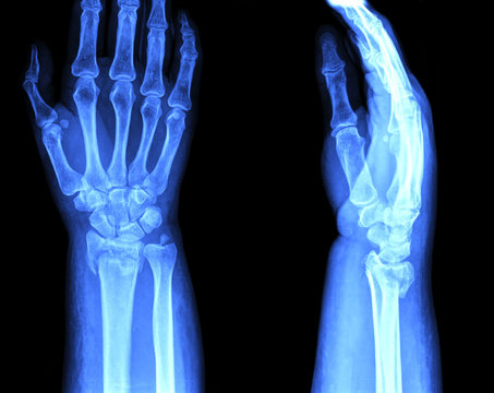 xray of hand two way