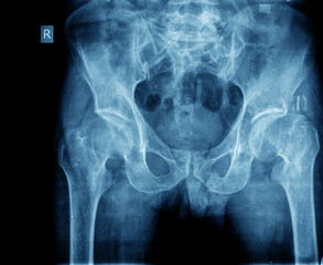 X-ray of the hip