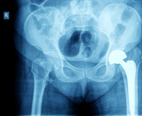 X-ray of the hip prosthesis