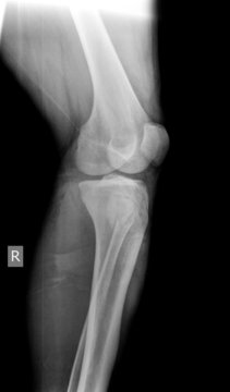 x-ray of knee
