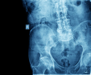 X-ray of the hip