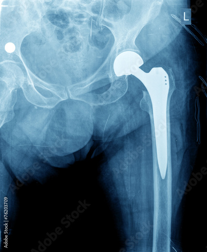 care of hip prothesis care of hip prothesis
