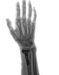 xray of human hand with screw front view