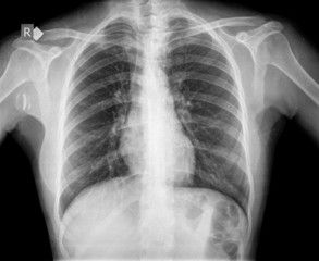 xray of chest