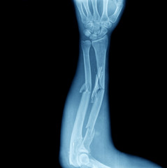 xray of broken arm