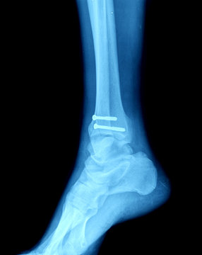 xray of foot with screw