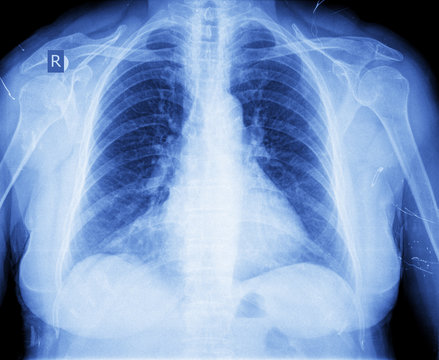 xray of chest