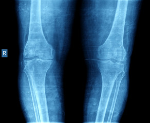 xray of knee