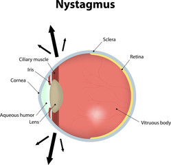 Nystagmus Labeled Diagram