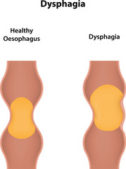 Dysphagia
